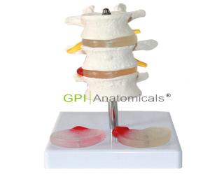GPI/A11119 3節腰椎附2個病變椎間盤模型